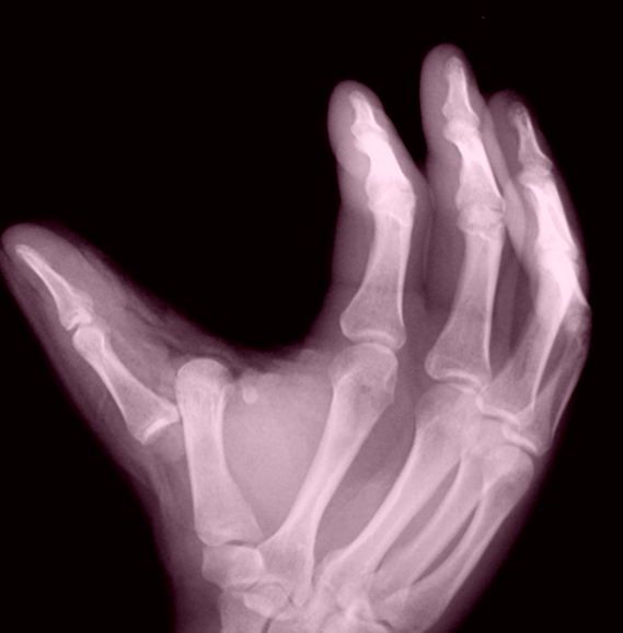 broken-thumb-pictures.png